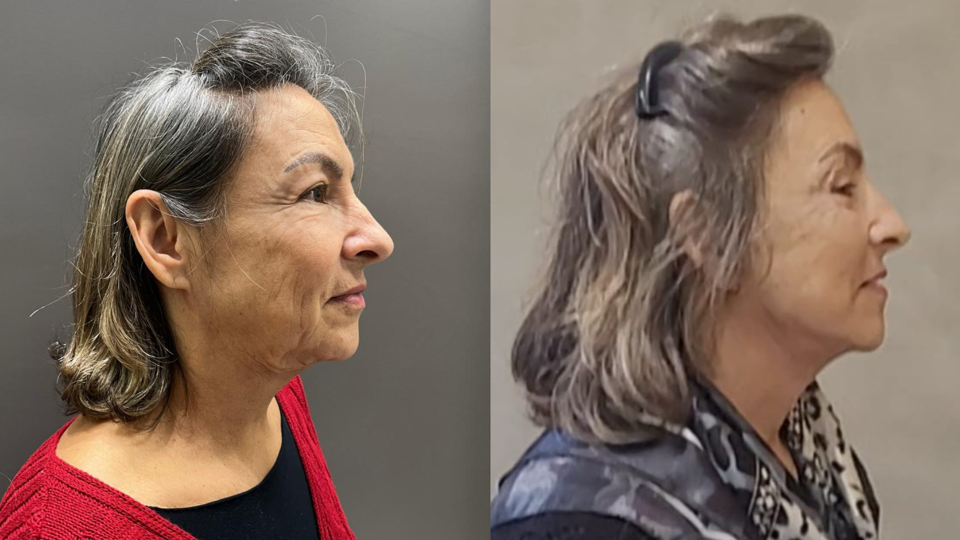 HarmonyLift® - Antes e Depois Harmonização Facial Londrina - Lifting Facial e Rejuvenescimento Natural no Norte do Paraná